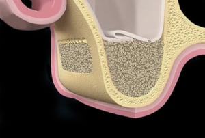 Sezione del mascellare superiore con innesto osseo stabilizzato all’interno del seno mascellare.