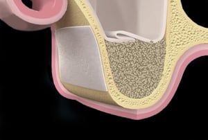 Procedura di apertura della parete laterale del mascellare superiore per accedere al seno mascellare.