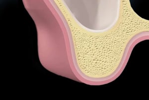 Immagine post-operatoria che mostra l’osso ricostruito nel seno mascellare pronto per l’inserimento implantare.