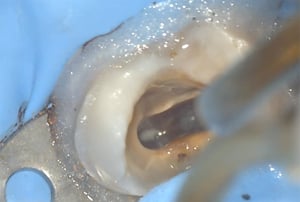 Ritrattamento endodontico al microscopio