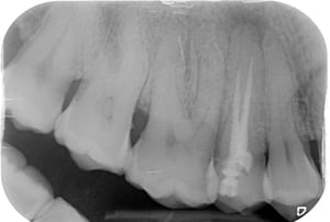 Ritrattamento endodontico al microscopio 1