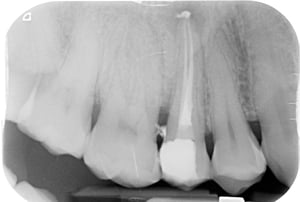 Ritrattamento endodontico al microscopio 2