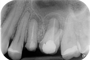 Ritrattamento endodontico e corone in zirconia prima
