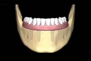 Vista frontale della mandibola con quattro impianti dentali inseriti