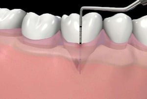 Illustrazione di una sonda parodontale che misura la profondità della tasca gengivale accanto a un molare.