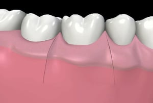 Ricostruzione grafica di gengiva sana che ricopre completamente il dente dopo trattamento rigenerativo.