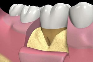 Immagine 3D che mostra innesto osseo e membrana riassorbibile applicata per la rigenerazione parodontale.