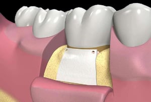 Illustrazione di una membrana protettiva fissata per favorire la rigenerazione ossea intorno al dente.