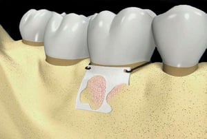 Immagine 3D che mostra difetto osseo parodontale prima del riempimento rigenerativo.