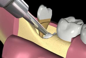 estrazione denti del giudizio