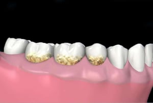 Rappresentazione grafica di denti con accumulo di tartaro e placca prima della pulizia dentale