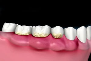 Illustrazione del trattamento odontoiatrico con strumento rotante per la rimozione del tartaro