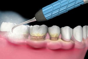Pulizia dentale professionale con strumento rotante e pasta lucidante