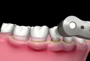 Denti ricoperti da placca e tartaro prima del trattamento odontoiatrico