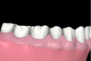 Denti puliti e gengive sane dopo seduta di igiene orale professionale