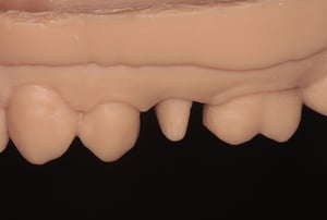Corona in zirconia monolitica premolare