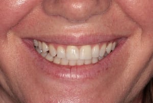 Ricostruzioni estetiche incisivi superiori