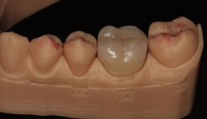 Intarsio overlay e.max e impronta ottica