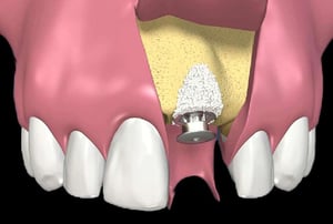 Schema odontoiatrico con apertura gengivale per posizionamento impianto dentale.
