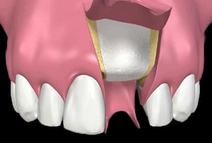 Immagine 3D di inserimento vite implantare nella mascella superiore.