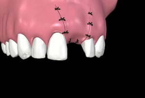 Render medico di impianto dentale con vite posizionata nell’osso mascellare.