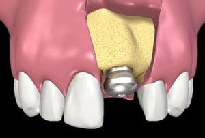 Illustrazione odontoiatrica con cappetta dell’impianto visibile sotto gengiva.