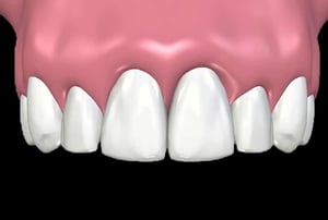 Render odontoiatrico con posizionamento finale dell’impianto dentale nella mascella superiore.