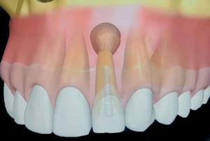 Illustrazione 3D che mostra una lesione apicale (granuloma o cisti) sopra un incisivo, visibile attraverso un modello trasparente della radice dentale