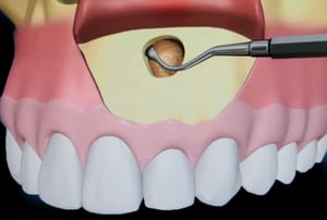 Illustrazione 3D della fase iniziale dell’intervento di microchirurgia endodontica con apertura della corticale ossea sopra l’apice del dente
