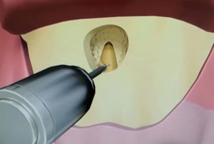 Illustrazione 3D dell’estrazione della lesione apicale con pinza chirurgica durante la microchirurgia endodontica