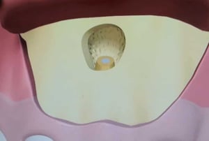 Illustrazione 3D della lesione apicale in fase di rimozione con cucchiaio chirurgico, evidenziando la cavità ossea circostante