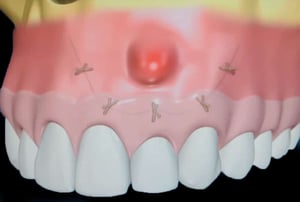 Illustrazione 3D della gengiva suturata dopo l’intervento di microchirurgia endodontica, con punti di sutura e zona di intervento visibile