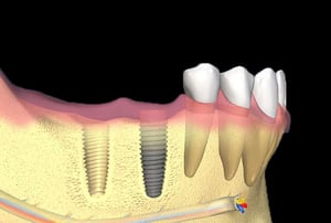 Due impianti dentali inseriti nell’osso mandibolare accanto ai denti naturali