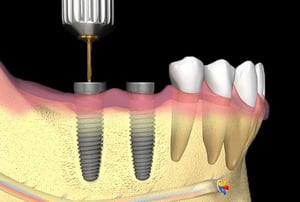 Vista gengivale con denti mancanti in attesa di impianto