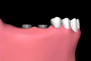 Applicazione della corona protesica su impianto dentale