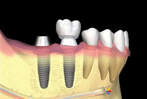 Gengiva con impianti dentali pronti per il montaggio della protesi