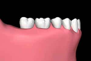 Avvitamento della protesi fissa sugli impianti dentali