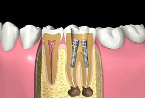 Illustrazione odontoiatrica che mostra una sezione del dente con impianti endodontici e innesto osseo.