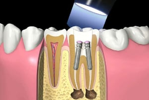 Illustrazione odontoiatrica che mostra una sezione del dente con impianti endodontici e innesto osseo.