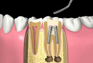 Illustrazione odontoiatrica che mostra una sezione del dente con impianti endodontici e innesto osseo.