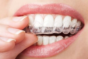 Primo piano di una persona che inserisce una mascherina trasparente per sbiancamento dentale, mostrando denti bianchi e gengive in salute.