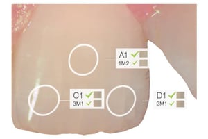 Analisi digitale del colore del dente con sistema di rilevamento cromatico per protesi estetiche.