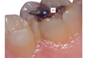 Scansione intraorale che mostra un molare con otturazione metallica e dettagli del tessuto gengivale.