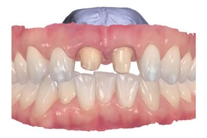 Immagine 3D di un’arcata dentale con due denti limati per la realizzazione di corone.