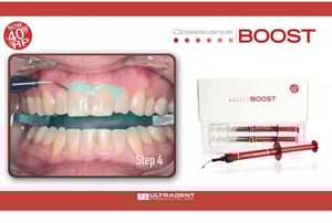 Kit di sbiancamento dentale Boost